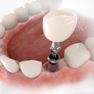 Digital image of the dental implant parts